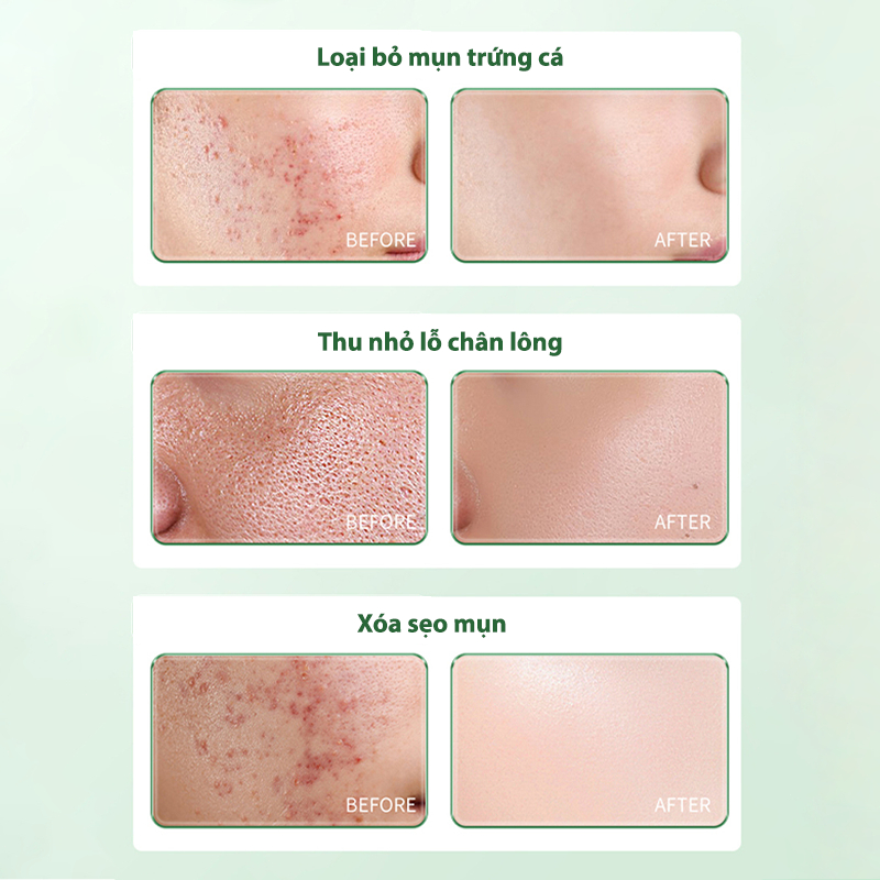 Kem mụn Kem chấm mụn cấp tốc Loại bỏ sẹo mụn Phục hồi và làm sáng sẹo mụn bằng 30g