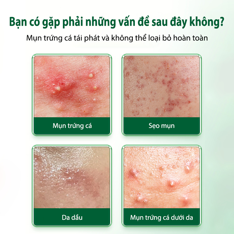 Kem mụn Kem chấm mụn cấp tốc Loại bỏ sẹo mụn Phục hồi và làm sáng sẹo mụn bằng 30g