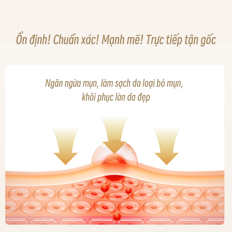 Kem mụn Kem chấm mụn cấp tốc Loại bỏ sẹo mụn Phục hồi và làm sáng sẹo mụn bằng 30g
