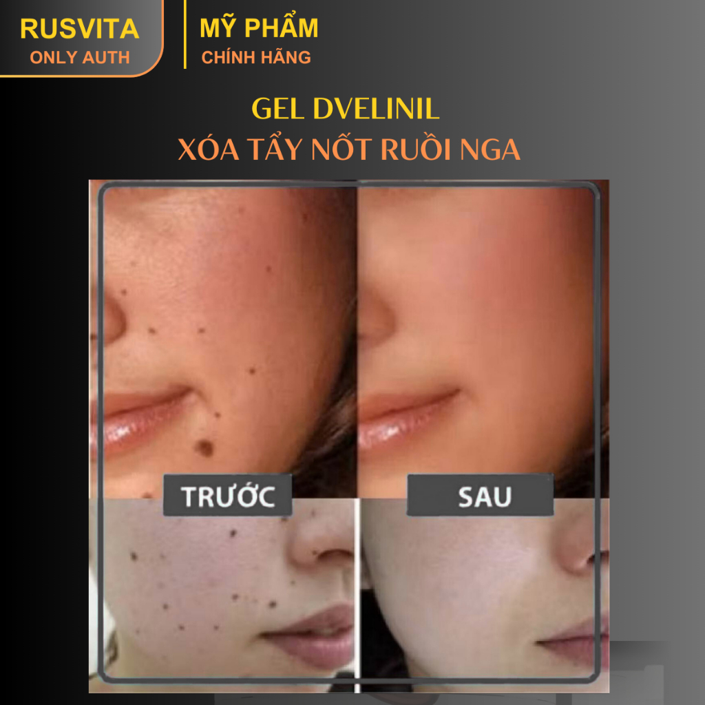 [Tẩy nốt ruồi DVELINIL nhập khẩu Nga chính hãng] Xoá nốt ruồi, mụn cóc, mụn thịt an toàn hiệu quả