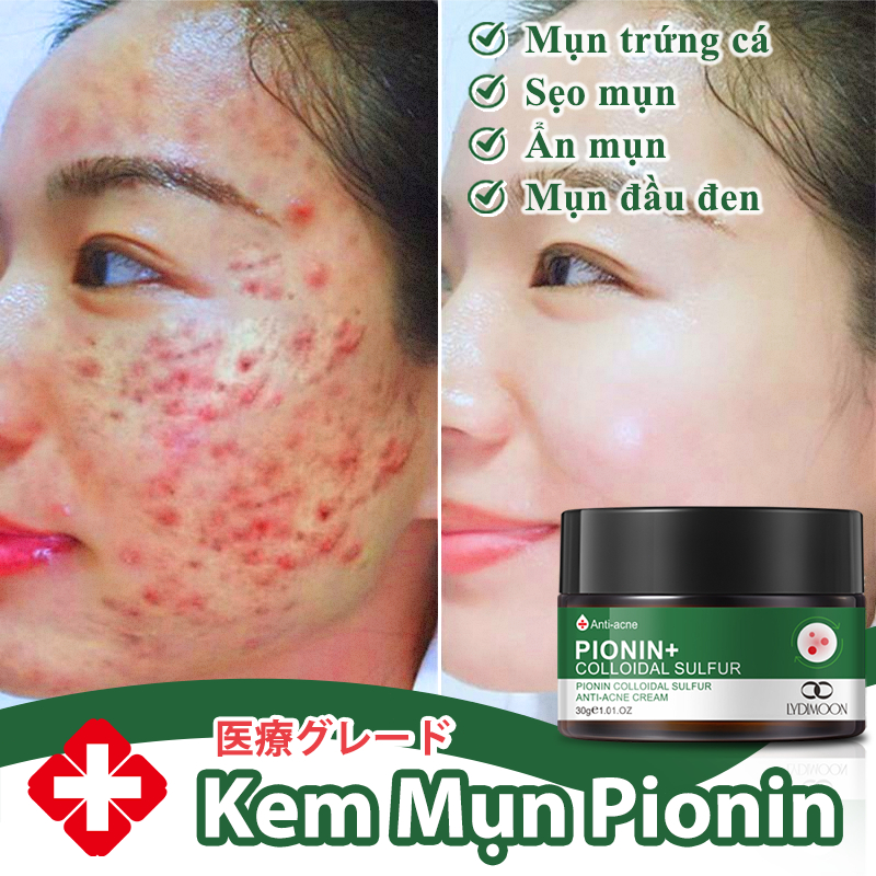 Kem mụn Kem chấm mụn cấp tốc Loại bỏ sẹo mụn Phục hồi và làm sáng sẹo mụn bằng 30g