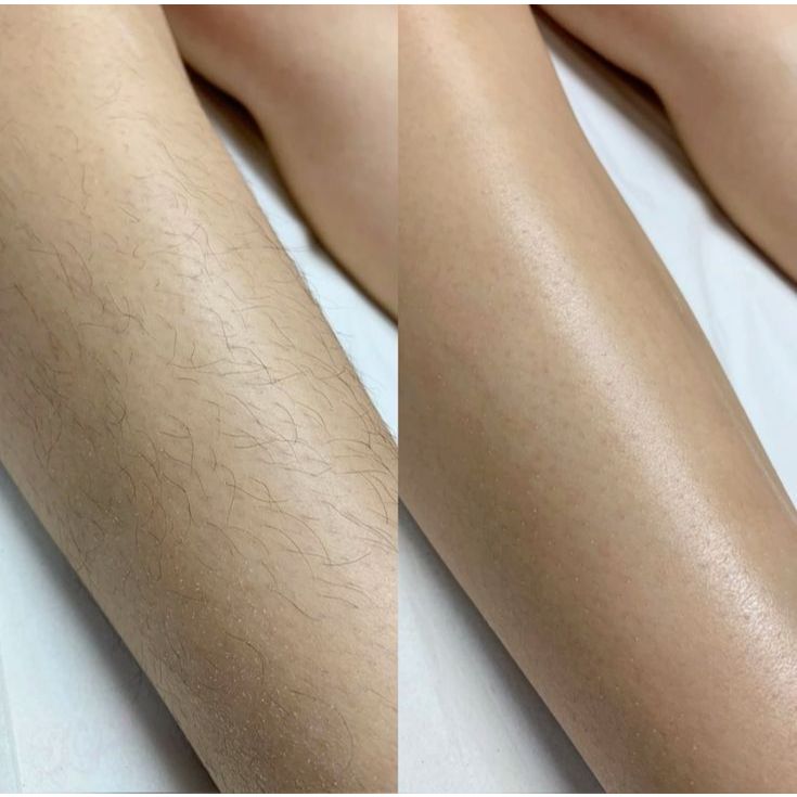 Máy triệt lông cá nhân công nghệ kép IPL&AFT, cảm biến màu da tự động Homedics Duo LUX IPL HH390