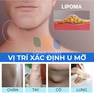 Kem Bôi Tan U Mỡ U Bã Đậu SUMIFUN LIPOMA Mỹ Giúp Tan Khối U Mỡ U Bã Đậu Hiệu Quả Giảm Sưng Đau