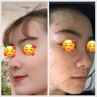 COMBO GEL MỤN + SỮA RỬA MẶT B5