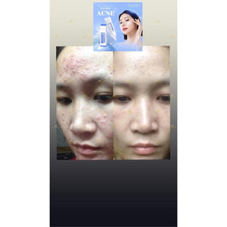 COMBO GEL MỤN + SỮA RỬA MẶT B5