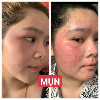 BỘ Mụn Ngày Đêm ( kem mụn x5 + Gel mụn)