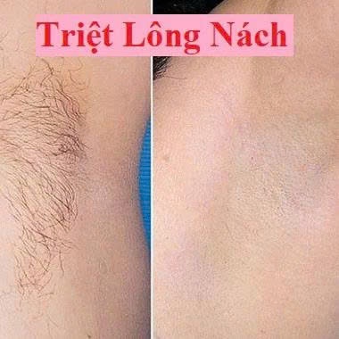 Mỡ trăn N STORE triệt lông, mỡ trăn N STORE wax lông gia nhiệt, dương mềm da, lành vết bỏng, giảm thâm  Chính Hãng