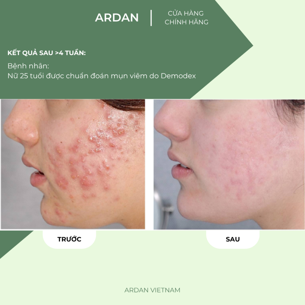 Serum Giảm Mụn, Mờ Thâm ARDAN 20ml - Mụn Viêm, Mụn Ẩn, Mụn Trứng Cá, Mụn Đầu Đen