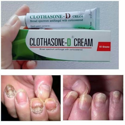 Kem thoa nấm móng tay, chân  Cream 15gr Thái Lan