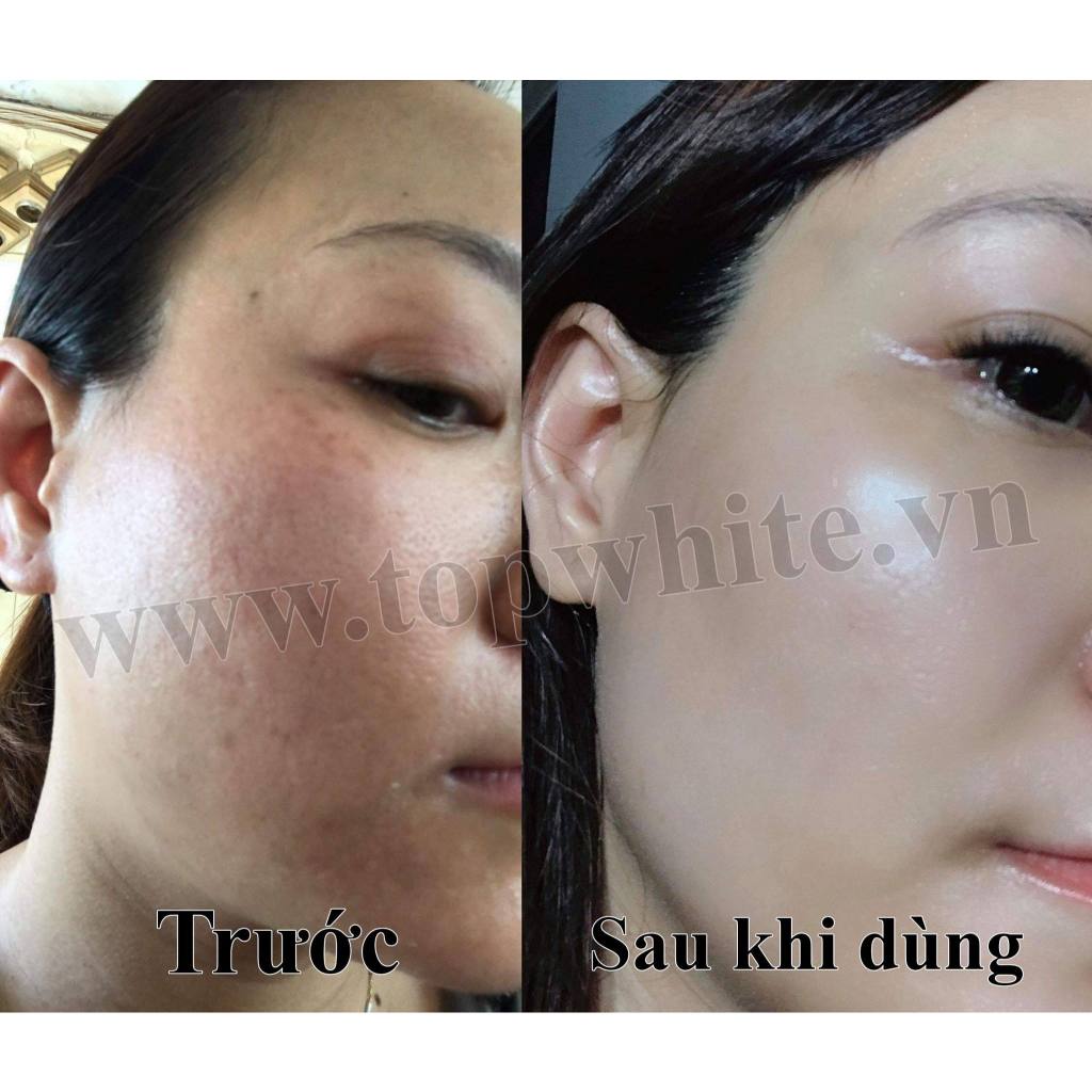 Kem giúp tái tạo da, làm mờ vết nám, tàn nhang, dưỡng trắng da Top White – White Perfect D1