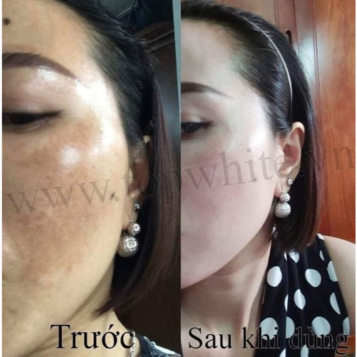 Kem giúp tái tạo da, làm mờ vết nám, tàn nhang, dưỡng trắng da Top White – White Perfect D1
