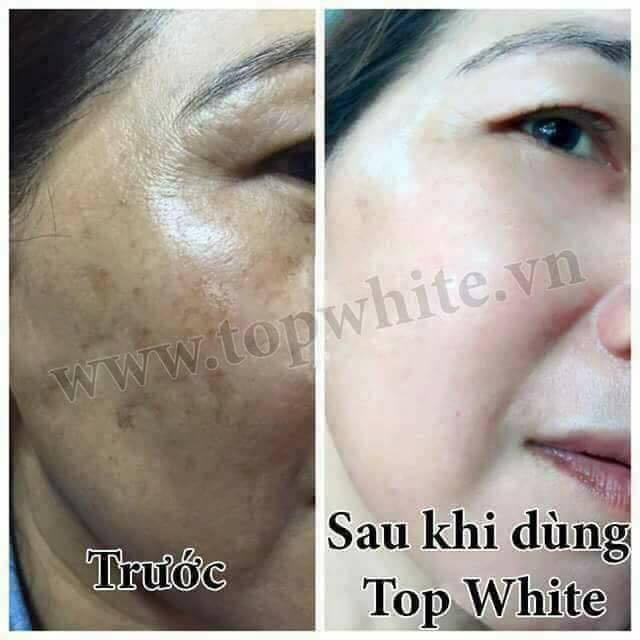 Kem giúp tái tạo da, làm mờ vết nám, tàn nhang, dưỡng trắng da Top White – White Perfect D1