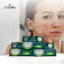 3 Tuýp Kem Giảm Mụn Mủ, Mụn Bọc, Mụn Trứng Cá Acnevir Santafa Fobe tuýp 10gr