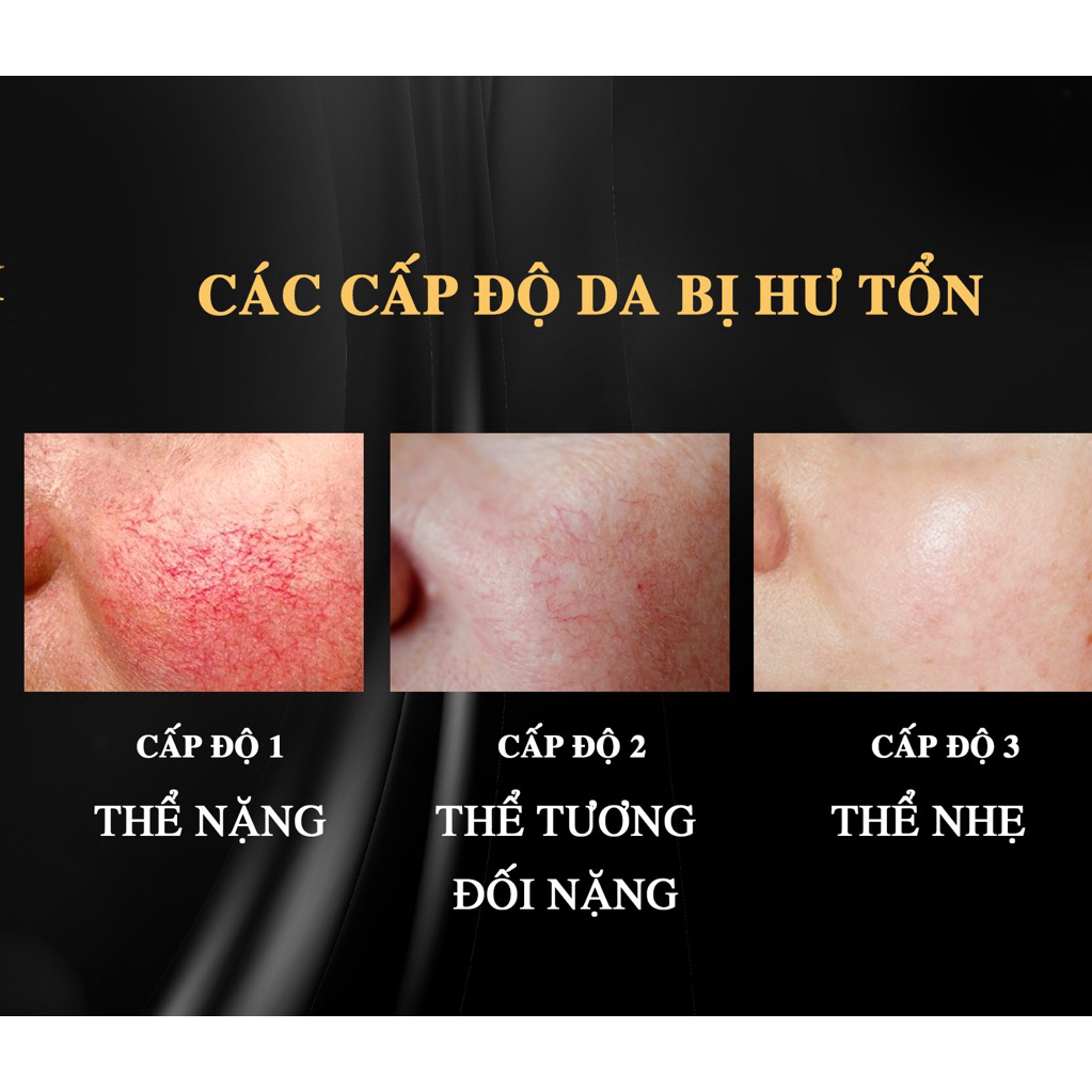 [Hot] Kem Mao Mạch Baby Milk Phục Hồi Da Mỏng Đỏ Nhiễm Corticoid 20g - Hàng Hiệu Cao Thiên Nhi