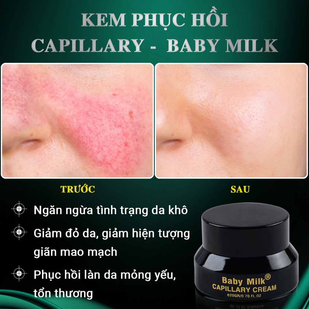 [Hot] Kem Mao Mạch Baby Milk Phục Hồi Da Mỏng Đỏ Nhiễm Corticoid 20g - Hàng Hiệu Cao Thiên Nhi