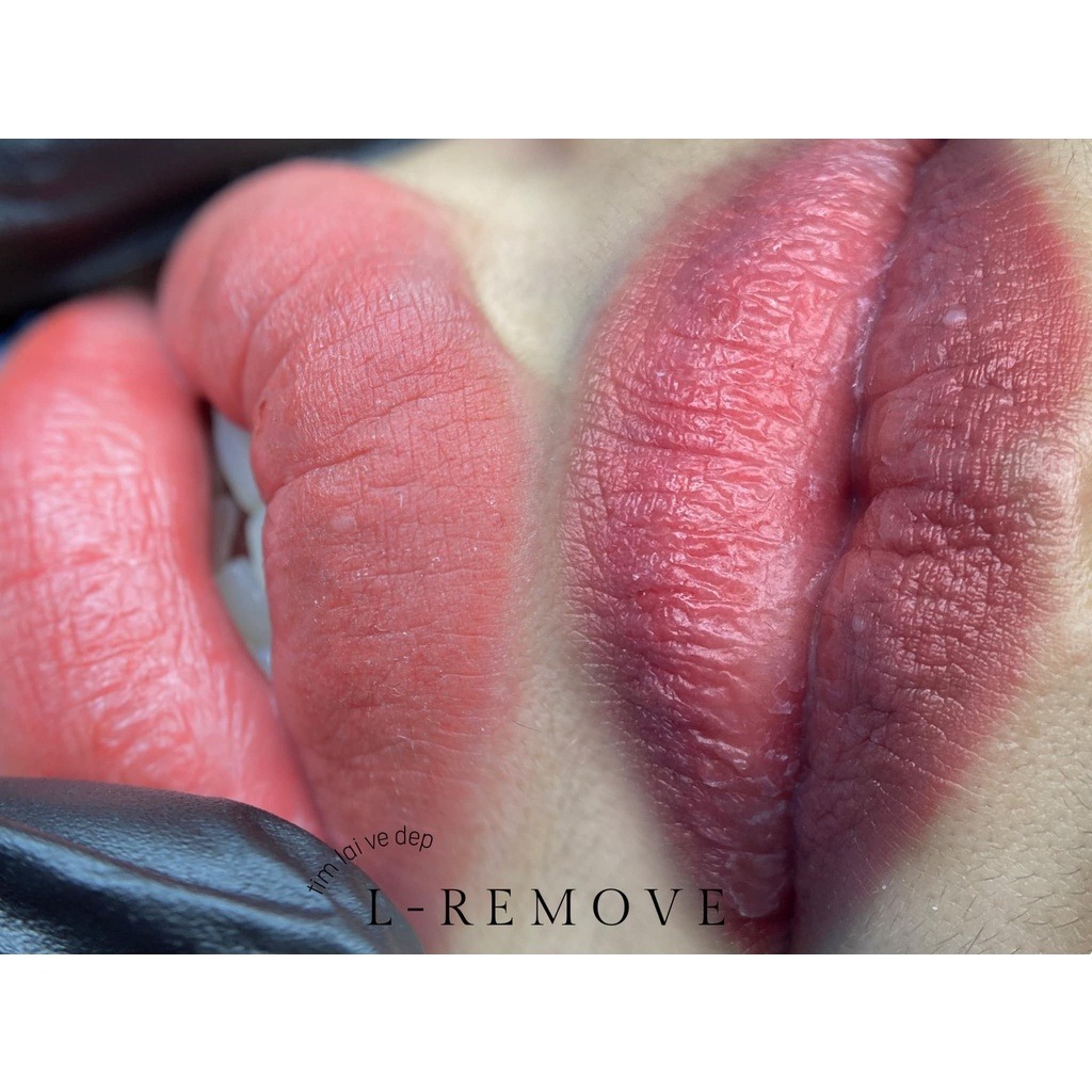 DUNG DỊCH XÓA PHUN XĂM L-REMOVE – AN TOÀN, NHANH, KHÔNG TỔN THƯƠNG DA