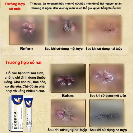 Kem Bôi Trĩ Nhật Bản SHORIN-Kem SHORIN Cải Thiện Tình Trạng Trĩ Ngoại Trĩ Nội Ngoại