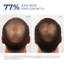 Tinh Chất Dưỡng Râu Nam 5% – Nuôi Dưỡng & Kích Thích Râu Tóc Mọc Tự Nhiên (Hộp 6 Lọ)