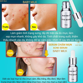 [Hot] Serum Acne Chấm Mụn Baby Milk 10ml - Hàng Hiệu Cao Thiên Nhi