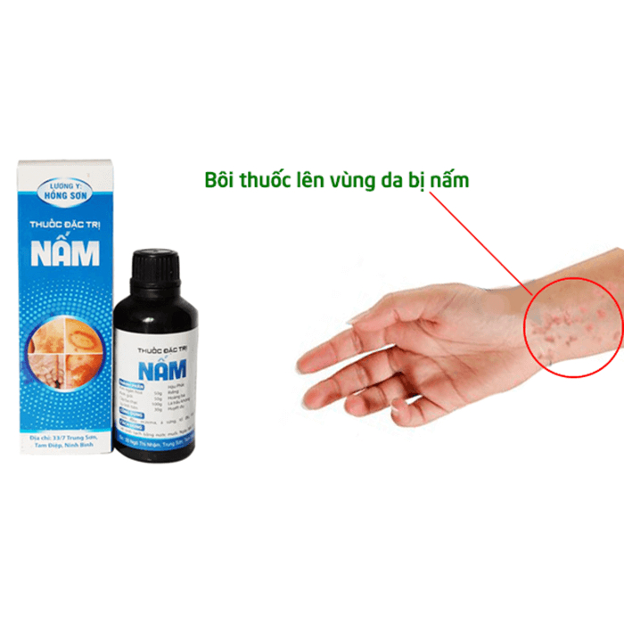 Nước bôi nấm lác, tổ đỉa hồng sơn