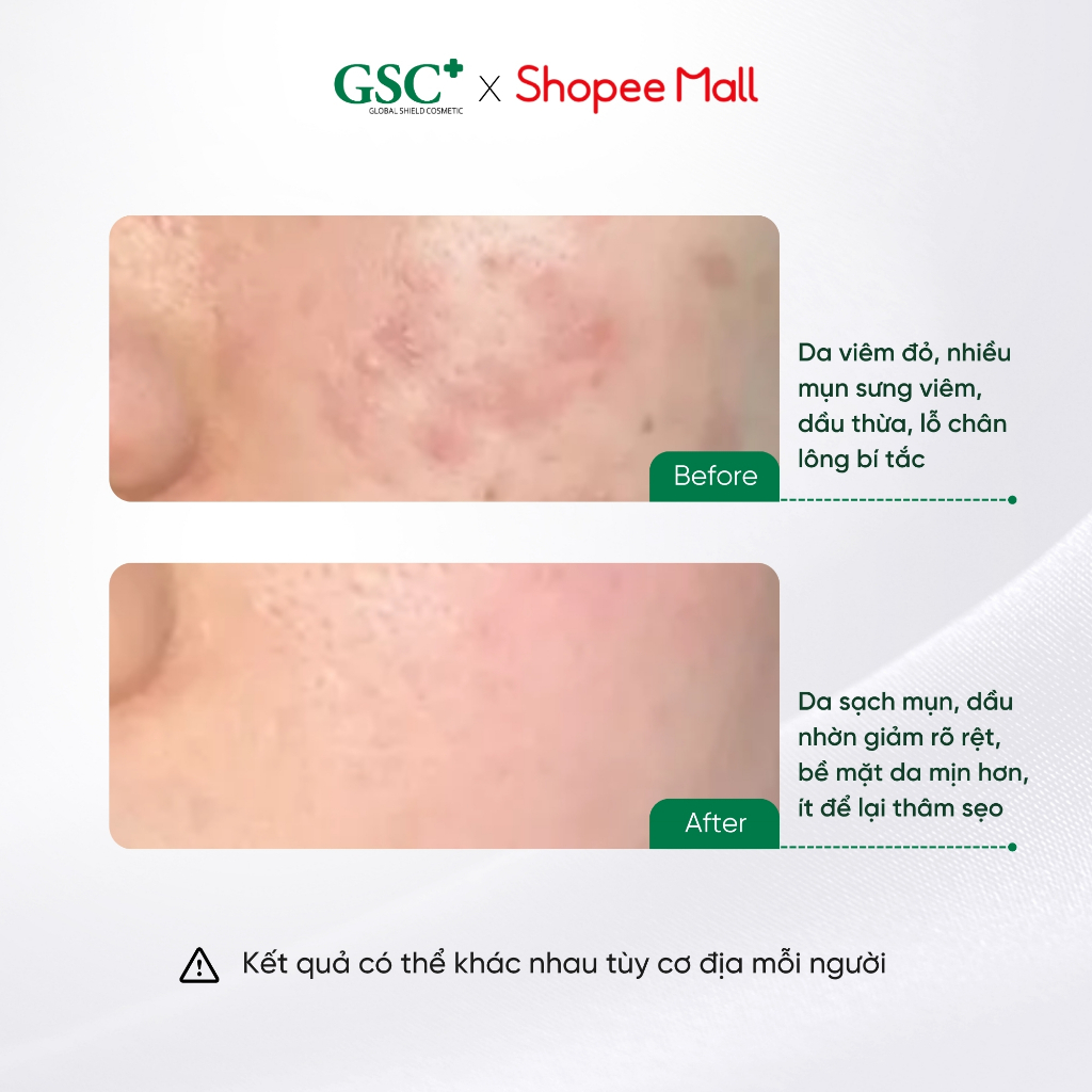 Tế Bào Gốc Hỗ Trợ Xử Lý Mụn Hàn Quốc GSC Acne Care Ampoule TR 8ml – Tế Bào Gốc Chống Viêm, Ngăn Ngừa Mụn Mới - GC085A