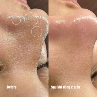Mặt Nạ Sủi Bọt Oxy The iLLON 10 Minute Mask (Hộp 5 Miếng) – Làm Sáng, Giảm Dầu& Thu Nhỏ Lỗ Chân Lông