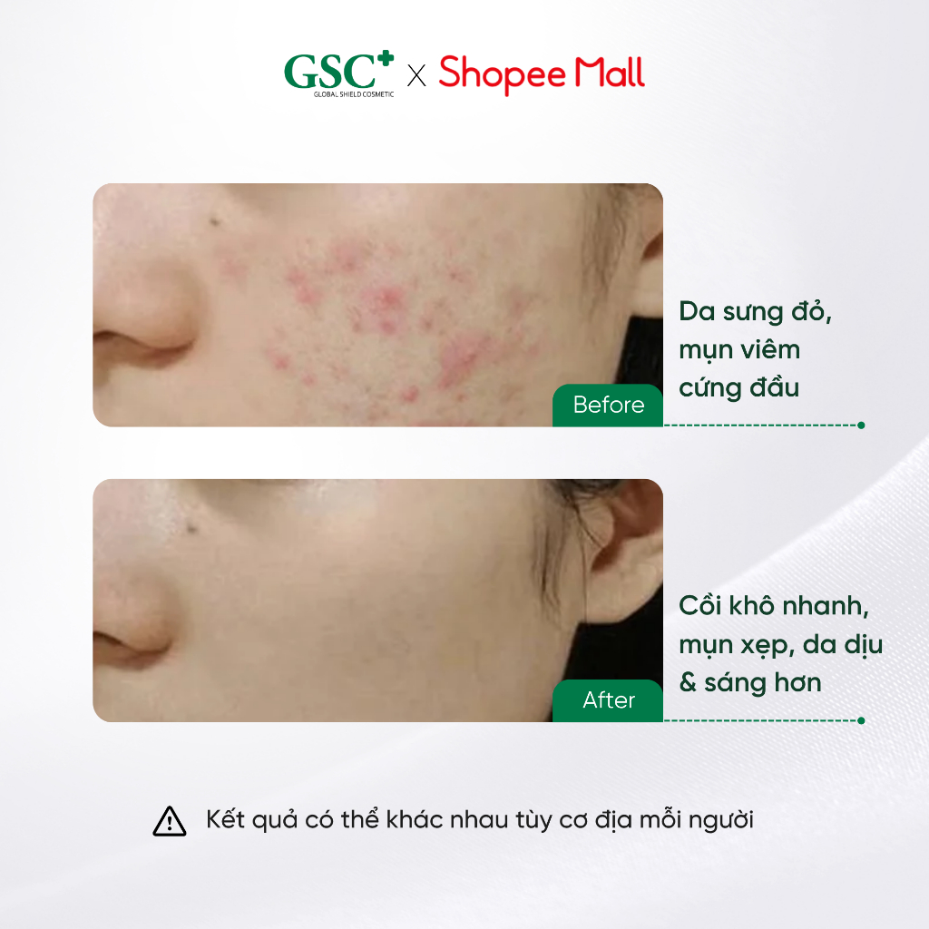 Serum Hỗ Trợ Xử Lý Mụn Nhanh 2 Ngày Hàn Quốc GSC Acne Clear Ampoule - Chấm Mụn Giúp Ngăn Ngừa Mụn Mới 15ml - GC081A