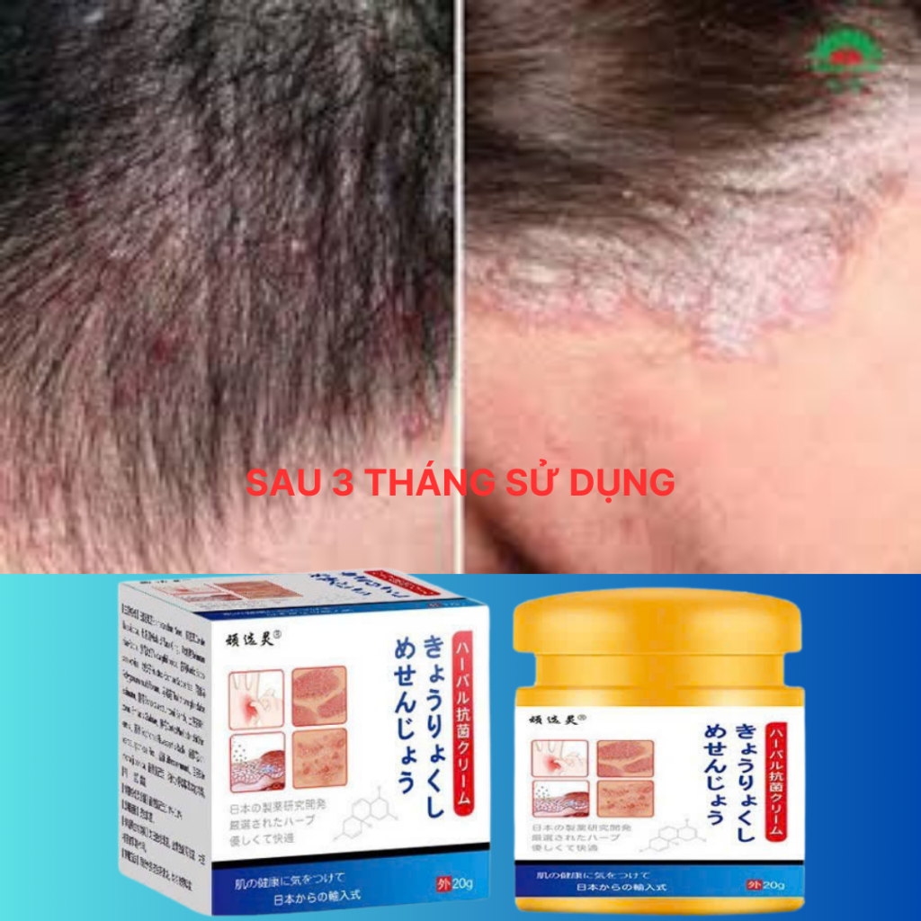 ( Chính hãng) Kem Bôi Da NHẬT BẢN Dứt Điểm Viêm Da Cơ Địa Nấm Ngứa, Hắc Lào, Tổ Đỉa, Ghẻ Nước
