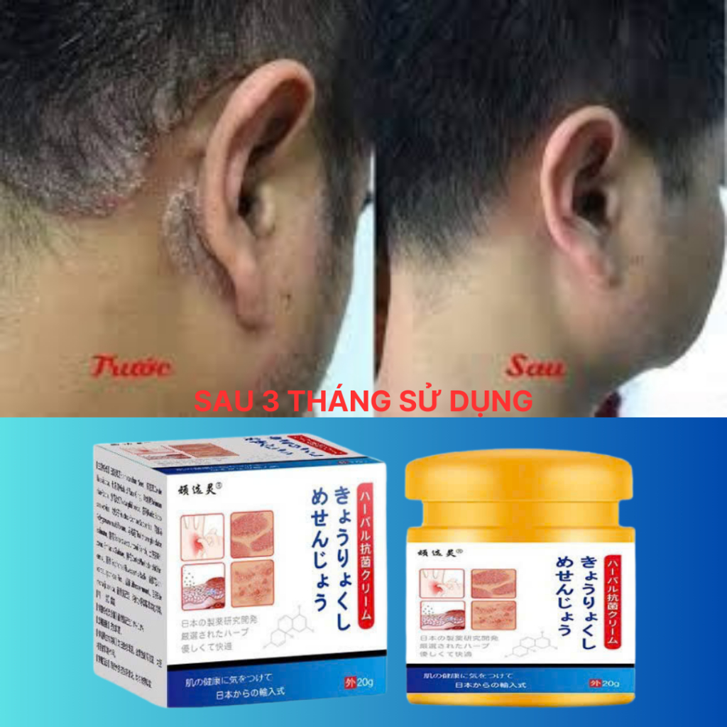 ( Chính hãng) Kem Bôi Da NHẬT BẢN Dứt Điểm Viêm Da Cơ Địa Nấm Ngứa, Hắc Lào, Tổ Đỉa, Ghẻ Nước