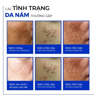 Combo Nám Đa Tầng Mocha & Retinol Mix Peel Hỗ Trợ Cải Thiện Nám Chuyên Sâu, Giúp Da Mịn Màng
