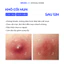 Gel chấm mụn SEVENLAB 15g giúp khô cồi mụn, làm dịu mụn viêm sau 12h hạn chế hình thành thâm sau mụn