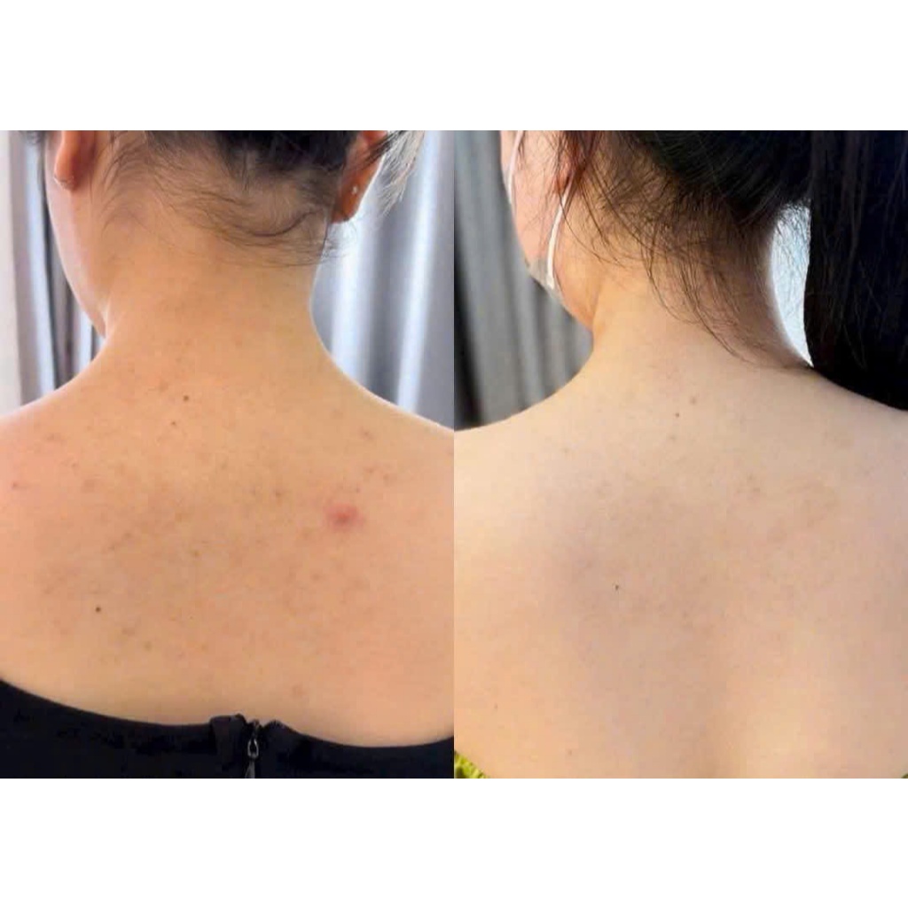 [ĐẠI LÝ CHÍNH HÃNG] Xịt Body Icon Skin Acne Free Solution Giảm Mụn, Dày Sừng Nang Lông Cơ Thể 100ml
