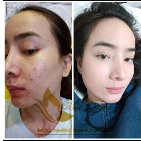 Chính Hãng Serum Linh Chi Tái Tạo Da Mộc Nhân Xóa Tan Mụn Nám Da không Đều Màu Lổ Chân Lông to