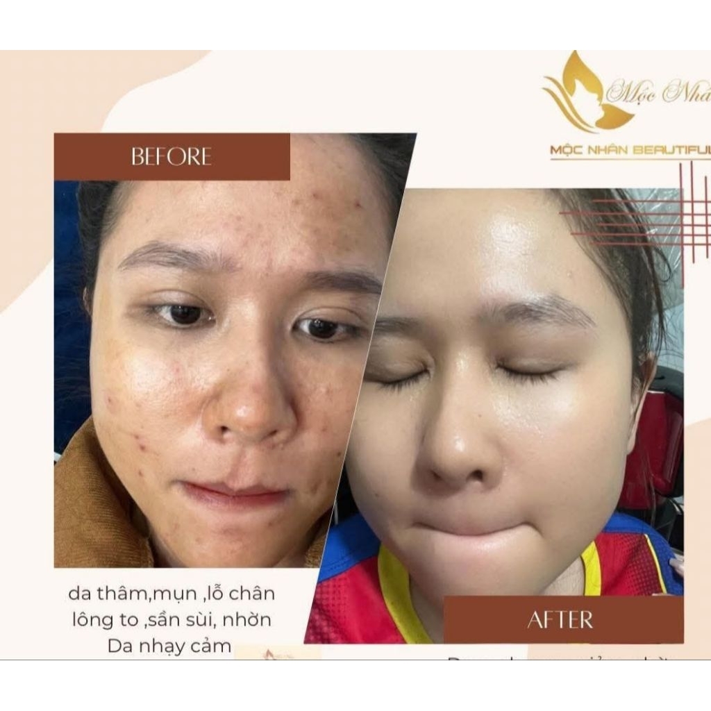 Chính Hãng Kem Cao Sâm Mộc Nhân T ái Tạo Loại Bỏ Mụn Nám Lổ chân lông to da ko đều màu