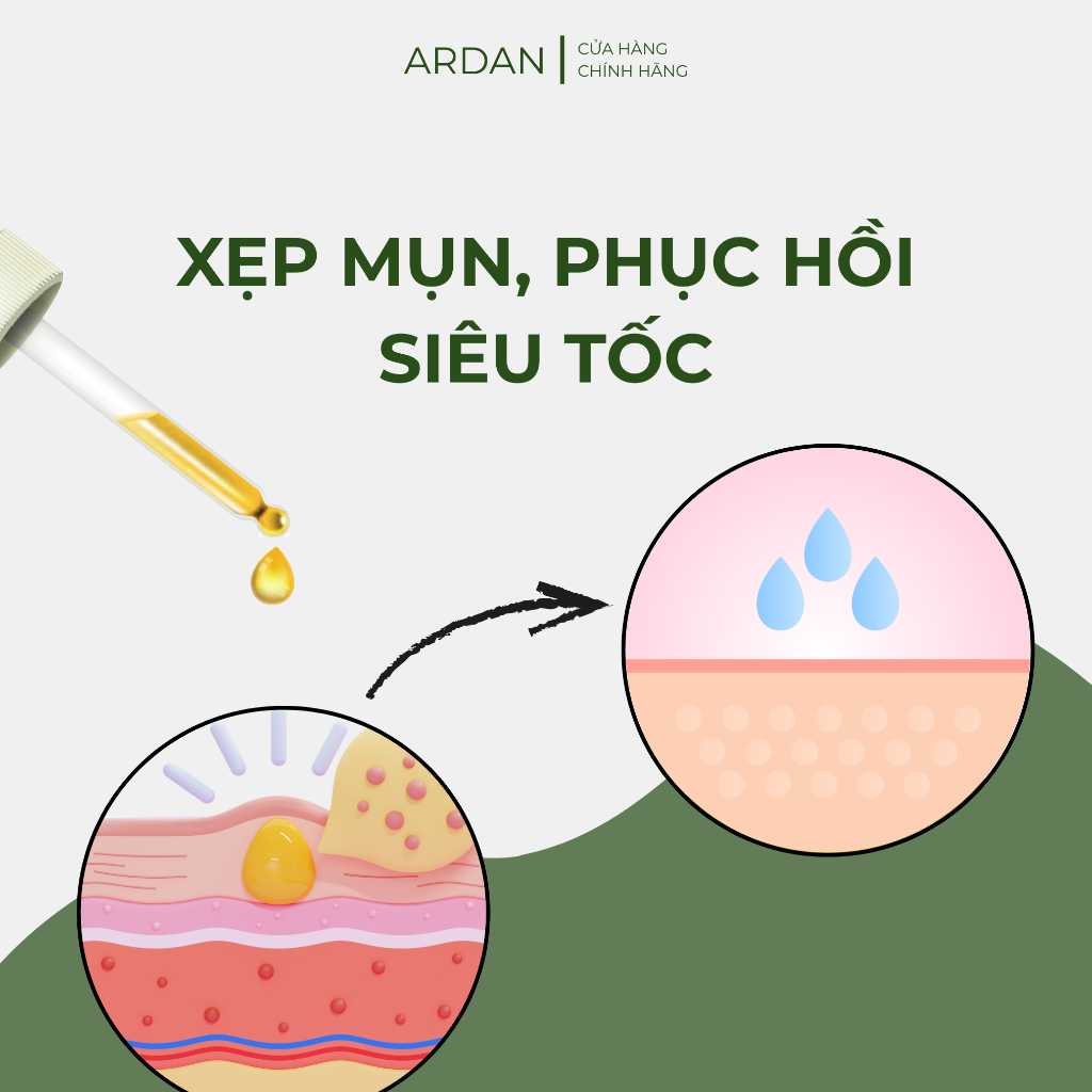 Serum Giảm Mụn, Mờ Thâm ARDAN 20ml - Mụn Viêm, Mụn Ẩn, Mụn Trứng Cá, Mụn Đầu Đen