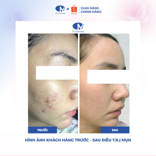 Serum Giảm Mụn Acncare Serum Dr Cosmess 30ml - Giảm Mụn Đầu Đen, Mụn Cám, Giảm Thâm Nhanh Chính Hãng