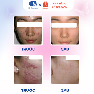 HIỆU QUẢ NHANH | Kem Chấm Mụn Acnecare AHA BHA 20g, Gom Cồi, Xẹp Mụn 24h Tiếng, Ngăn Mụn Dr Cosmess