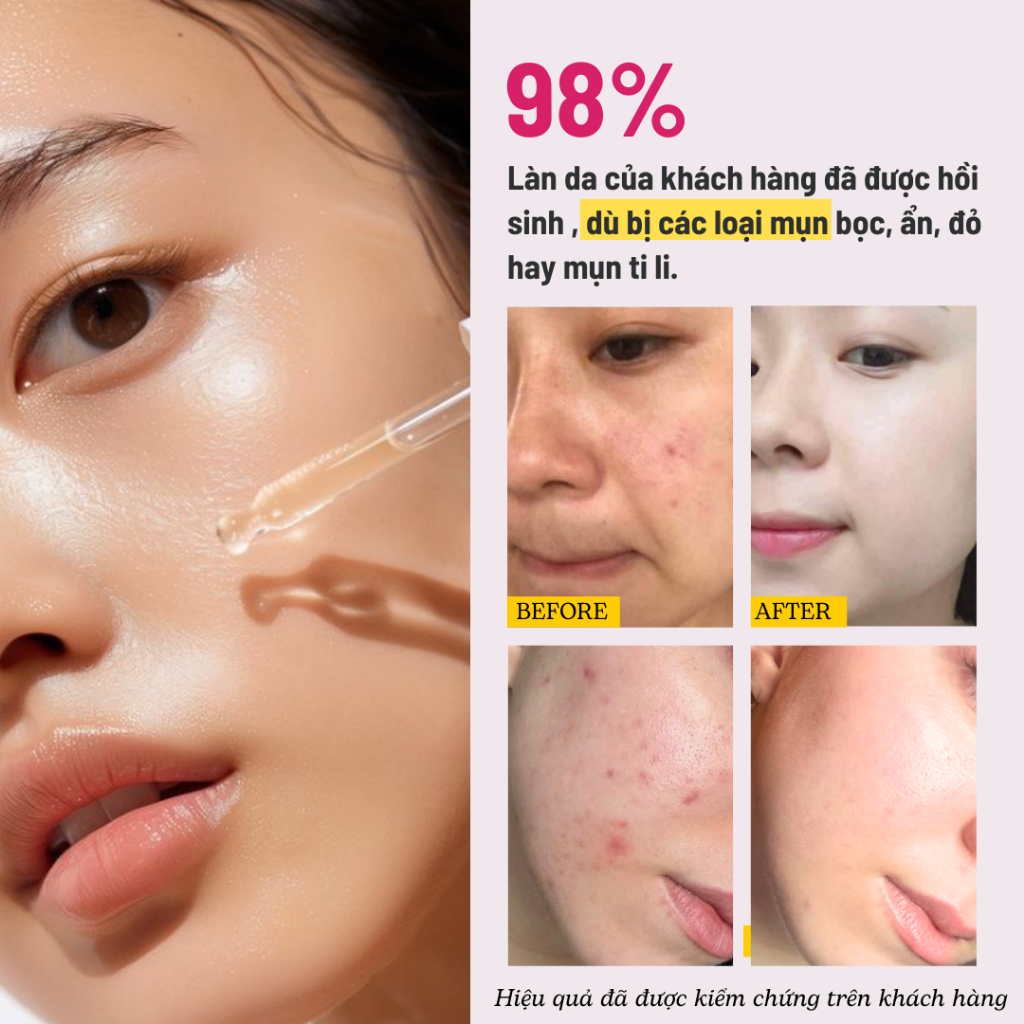 Serum Giảm Các Loại Mụn, Trắng Da, Mờ Thâm Mụn, Đều Màu Da, Phục Hồi Hàng Rào Bảo Vệ Da Hiệu Quả, Nhanh Chóng