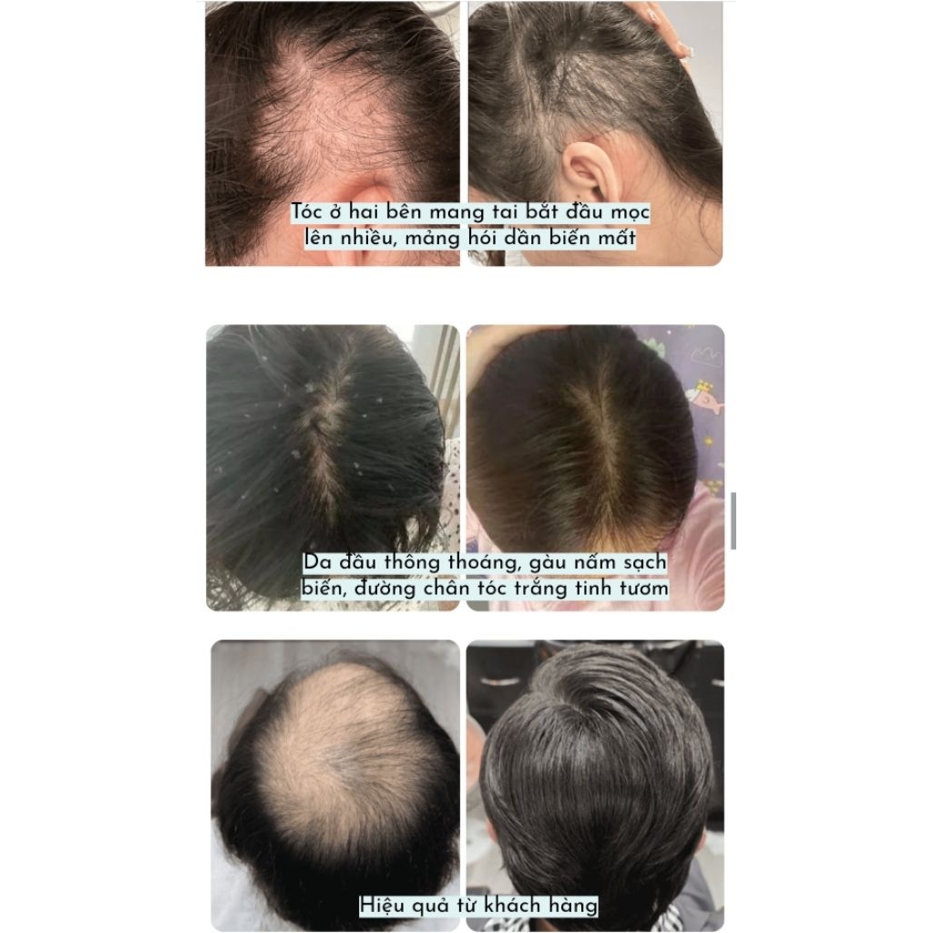 [Mua 3 Tặng 1 cùng loại] Serum Thảo Dược Quý Kích Thích Mọc Tóc - Herbal Hair Serum dạng Chai Lăn