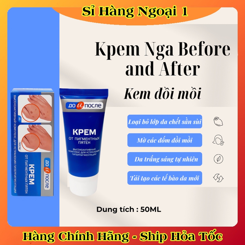 Kem Đồi Mồi Kpem Nga Hỗ trợ Mờ đồi mồi, Giúp trắng da, cấp ẩm cho da mịn màng