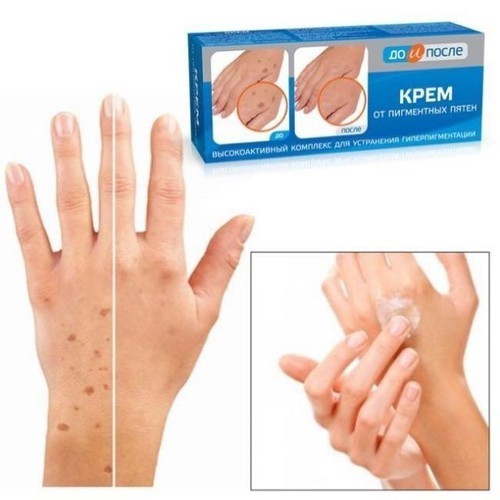 Kem Đồi Mồi Kpem Nga Hỗ trợ Mờ đồi mồi, Giúp trắng da, cấp ẩm cho da mịn màng