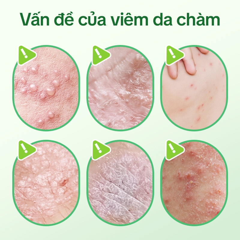 Tong Ren Tang Trà Thảo Mộc Cho Da – Hỗ Trợ Giảm Viêm Da, Ngứa, Eczema, Thanh Lọc Cơ Thể