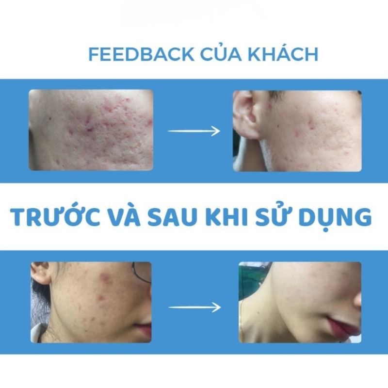 Miếng Dán Ngăn Ngừa Và Ép Sẹo Lồi, Sẹo Phì Đại Scar FX 2,5cm x 2,5cm của Rejuvaskin