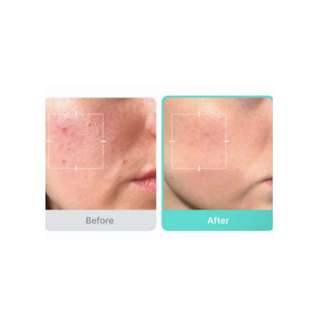 Serum/Sữa rửa mặt MEDICUBE Azelaic Acid Niacinamide