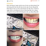 Máy Tẩy Trắng Răng Tại Nhà CONG FANSDR – Ánh Sáng Xanh + Gel Trắng Răng – Trắng Nhanh Không Ê Buốt – An Toàn- Trắng Lâu — ảnh 8