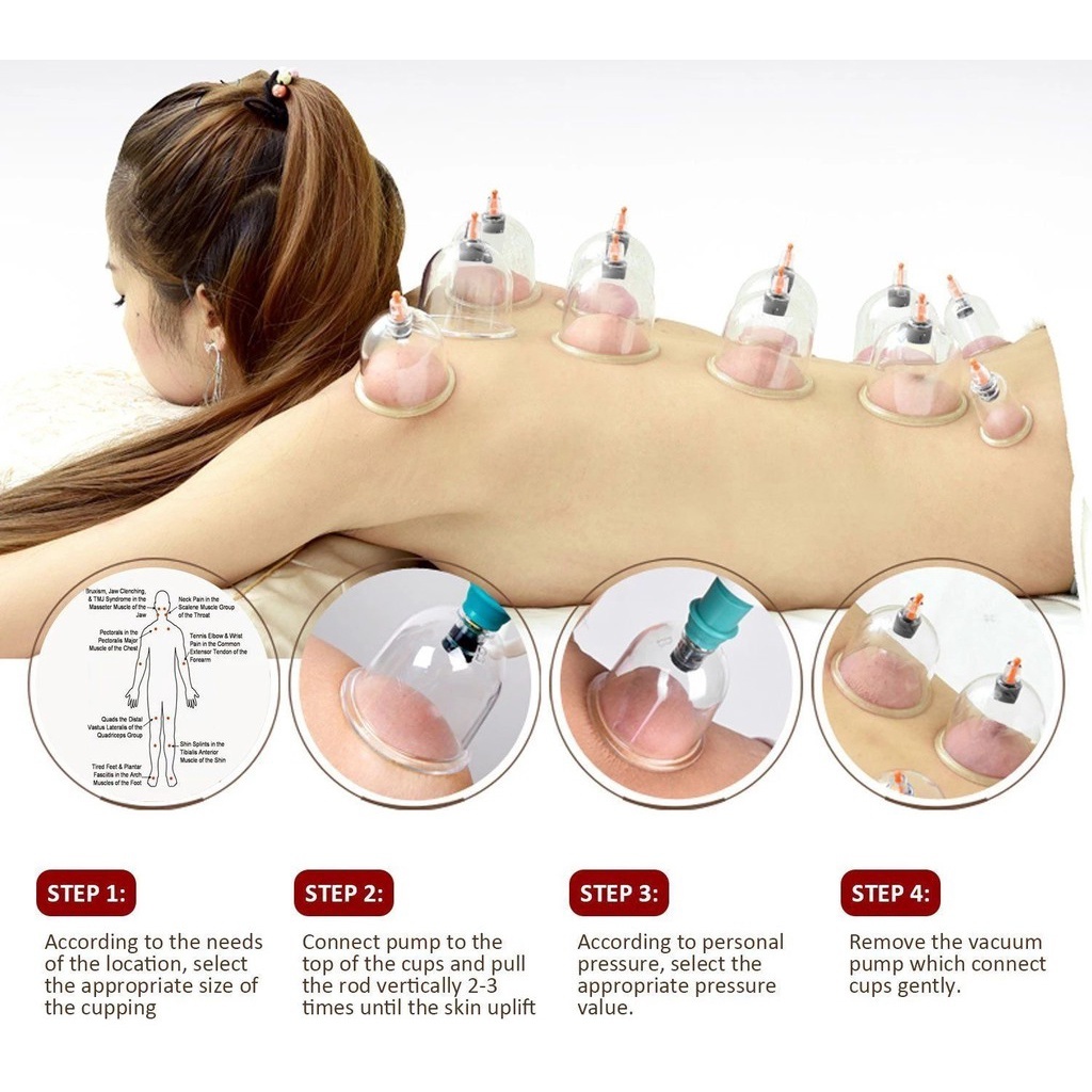 Bộ Giác Hơi Chân Không 12, 24, 32  Ly Không Dùng Lửa Giúp Điều Hoà Tuần Hoàn Máu, Thư Giãn Đả Thông Kinh Lạc