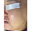 Tế bào Gốc Xử Lý Mụn Medula AC Ampoule