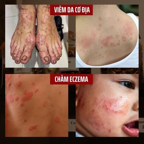 Cao bôi da liễu - viêm da cơ địa, nấm ngứa, chàm, á sừng, tổ đỉa, sủi mào gà, lậu giang mai, hắc lào, zona.. - Hũ 15g