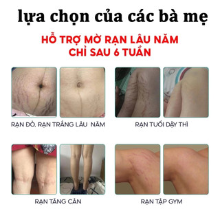 Kem Rạn Da cho bà bầu Loại bỏ sẹo sau khi mang thai Kem Chống Rạn Da 120g Giảm Rạn Hiệu Quả, Phục Hồi Da Nhanh Chóng