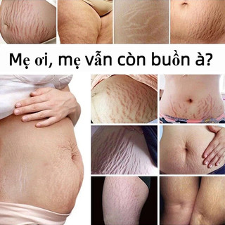 Kem Rạn Da cho bà bầu Loại bỏ sẹo sau khi mang thai Kem Chống Rạn Da 120g Giảm Rạn Hiệu Quả, Phục Hồi Da Nhanh Chóng